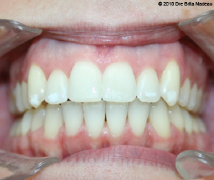 Marie-Hélène Cyr - Central intraoral view - After orthodontic treatments and orthognathic surgeries (January 29, 2010)